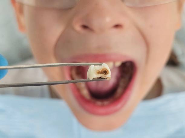 Best Emergency Treatment for Dental Infections or Abscesses in Aberdeen, OH